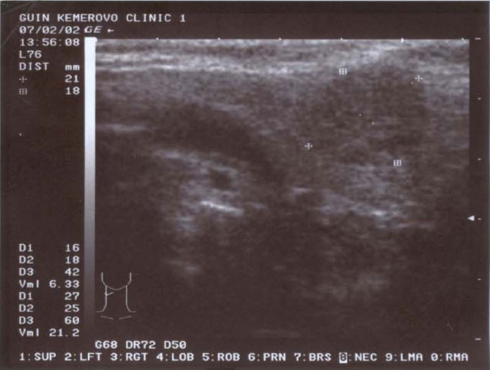 Гиперплазия щитовидной железы, узловой зоб 3 степени — СКЭНАР-терапия